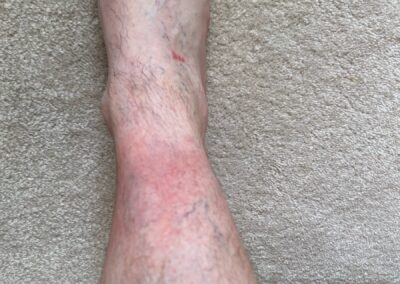 Some of the RAW results, chafed shin and ankle. Two days later