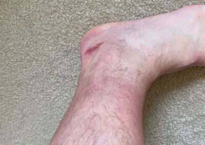 The other ankle, was very raw under the sock
